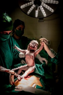 EMERGENCY's Maternity Centre, operating room, 2019. Birth of Kemeya’s daughter, by caesarean section. Kemeya is 36 years old; it is her fifth caesarean section.